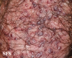 angiokeratoma of the scrotum