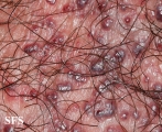 angiokeratoma of the scrotum