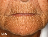 actinic elastosis