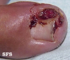 ingrowing nail