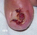 ingrowing nail