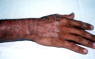 pellagra