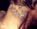 pellagra
