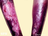 pellagra