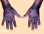 pellagra