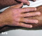 pellagra