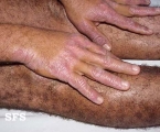 pellagra