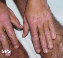 pellagra