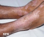 pellagra
