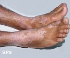 pellagra