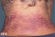 pellagra