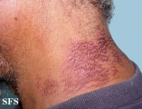 pellagra