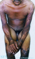 pellagra