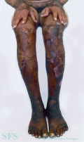 pellagra