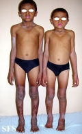pellagra