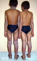 pellagra