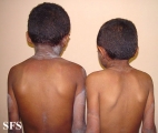 pellagra