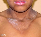 pellagra