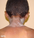 pellagra