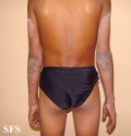 pellagra