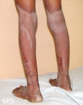 pellagra