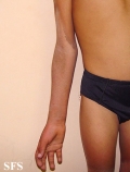pellagra