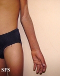 pellagra
