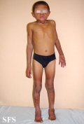 pellagra