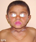 pellagra
