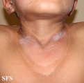 pellagra