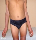 pellagra