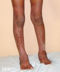 pellagra