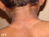 pellagra