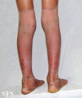 pellagra