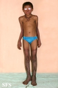 pellagra