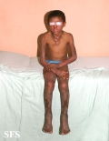 pellagra