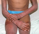 pellagra