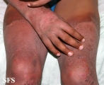 pellagra