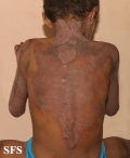 pellagra
