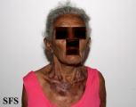 pellagra