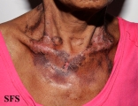 pellagra