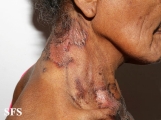 pellagra