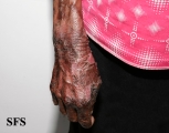 pellagra