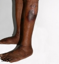 pellagra
