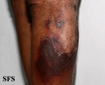 pellagra