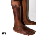 pellagra