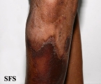 pellagra