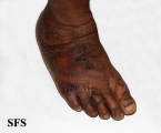 pellagra