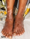 pellagra
