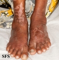 pellagra